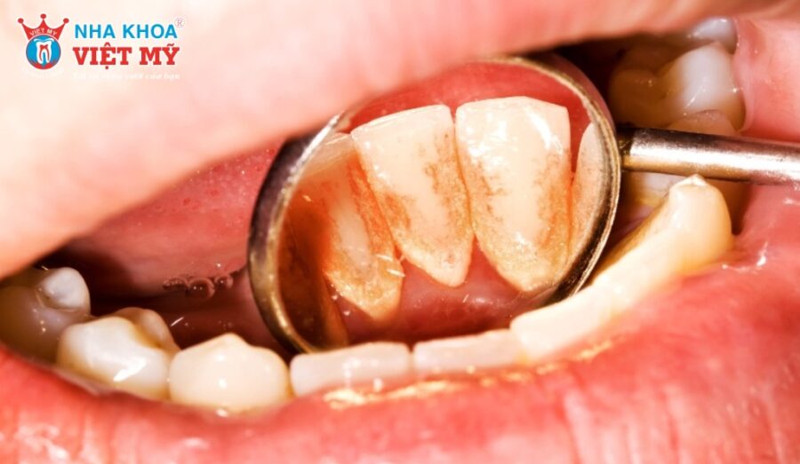 Hiện tượng vôi răng tự tróc là gì?