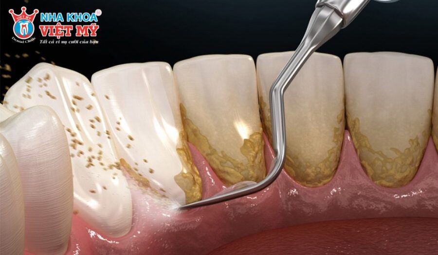 Nên lấy vôi răng bằng phương pháp chuyên khoa