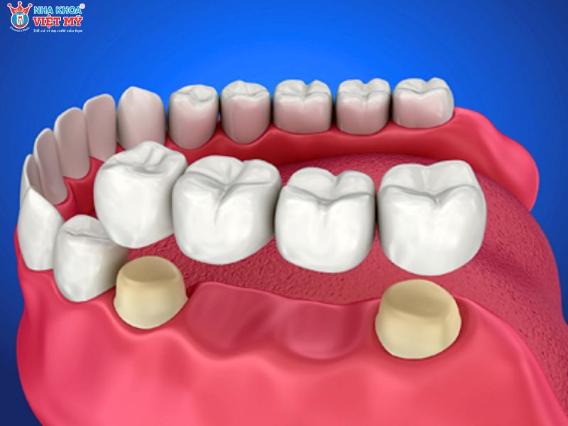 Giá bọc răng toàn sứ