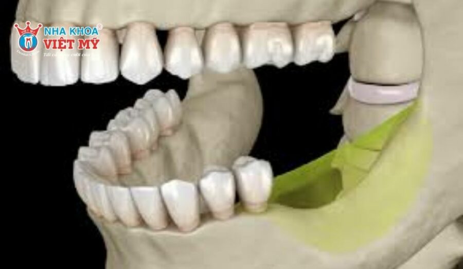 Trồng răng implant giúp ngăn chặn tình trạng tiêu xương