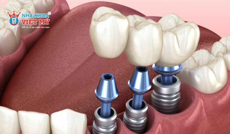 Thành phần cấu tạo trụ implant