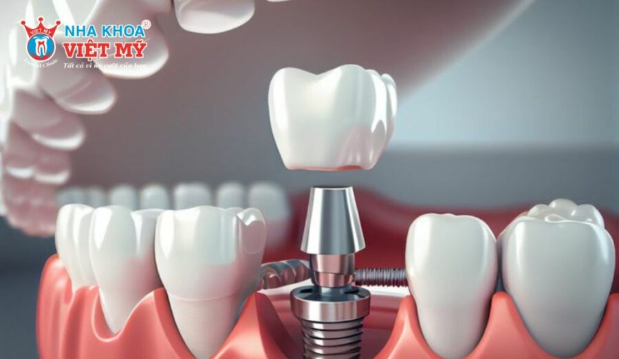 Phục hình răng sứ trên implant