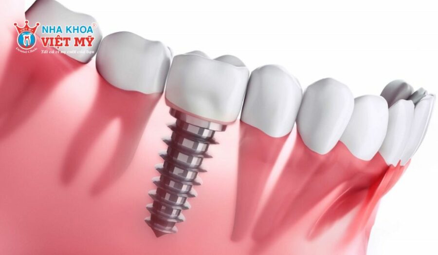 Các chi phí có thể phát sinh trong quá trình trồng implant
