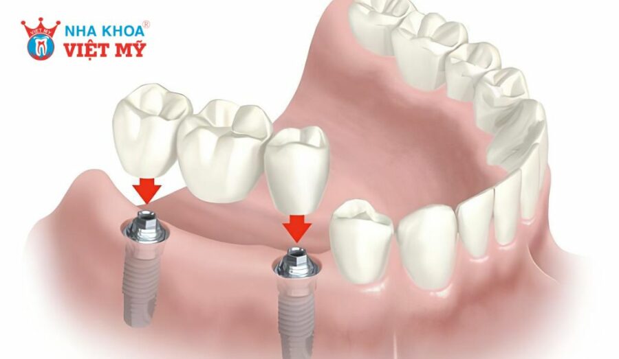 Phục hình cầu răng sứ trên implant