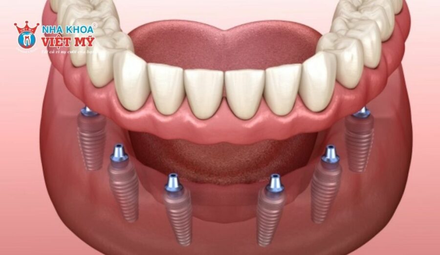Trồng răng implant bao nhiêu tiền phụ thuộc vào nhiều yếu tố