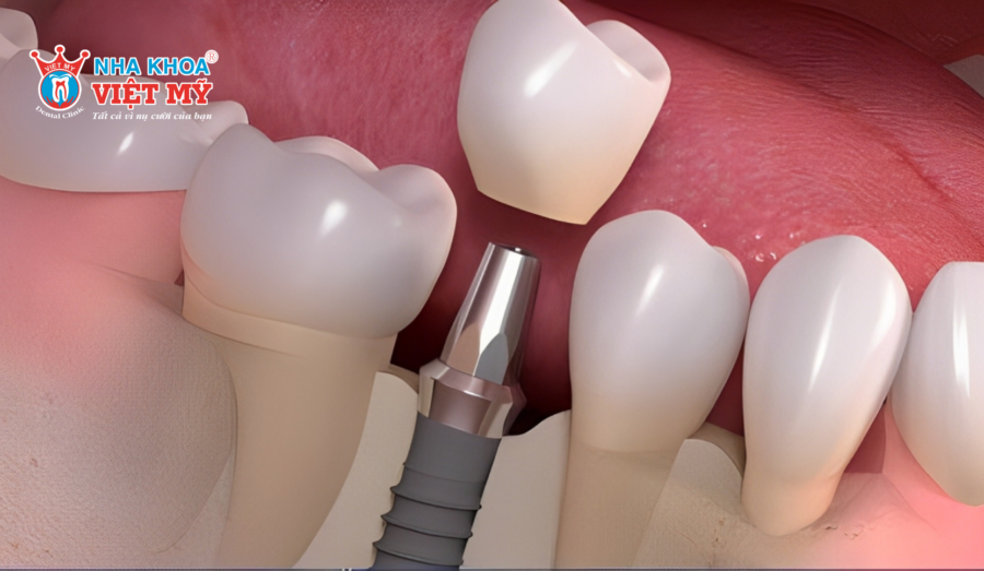 Độ bền và tuổi thọ của răng sứ kim loại và Titan