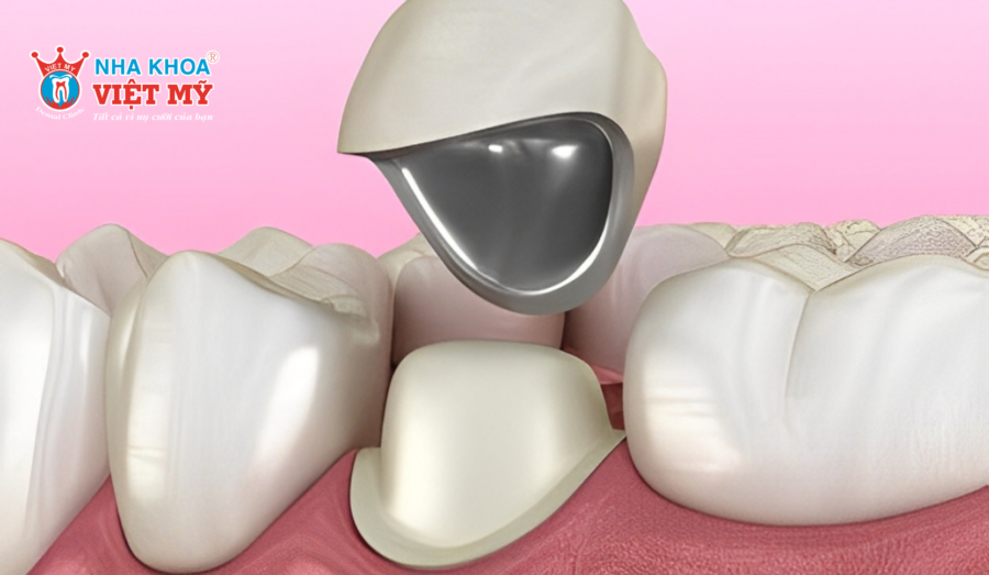 Vị trí thường được chỉ định bọc răng sứ kim loại và Titan chủ yếu là răng hàm