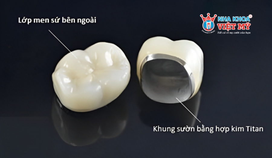 Cấu tạo của răng sứ Titan