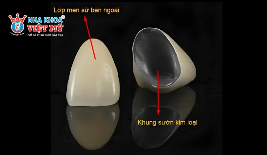 Cấu tạo của răng sứ kim loại
