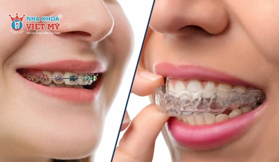 Niềng răng Zenyum không cần mắc cài và khí cụ chỉnh nha