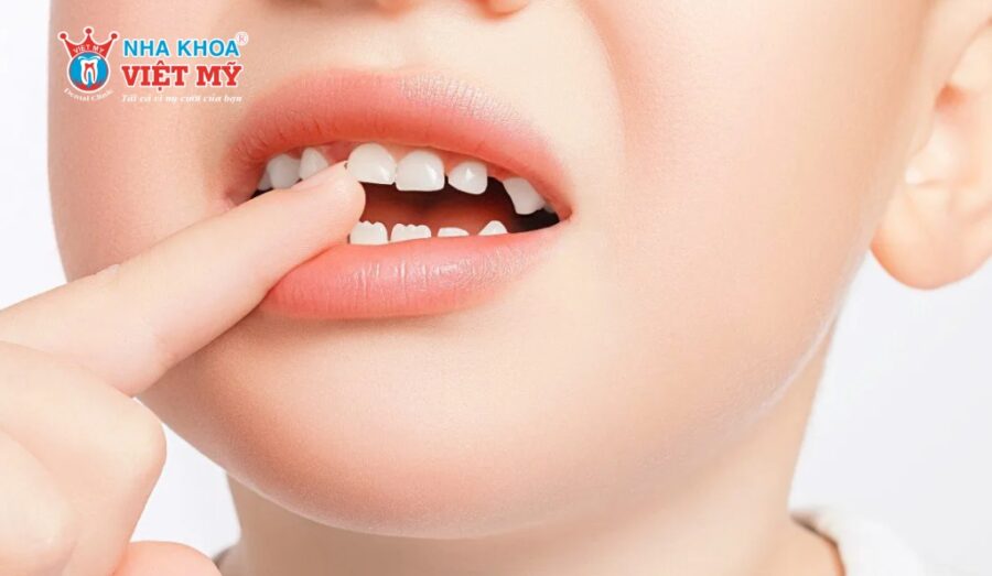 Răng lệch lạc, hô, móm khiến trẻ gặp khó khăn việc ăn nhai