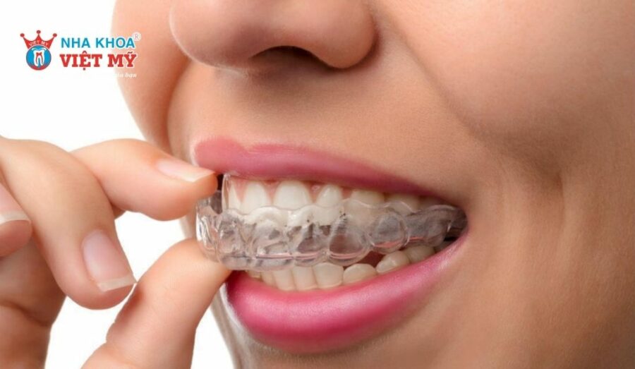Khay niềng Zenyum không tạo lực kéo mạnh nên không gây đau