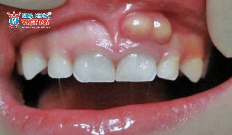 Viêm nướu là bệnh phổ biến ở răng miệng trẻ em