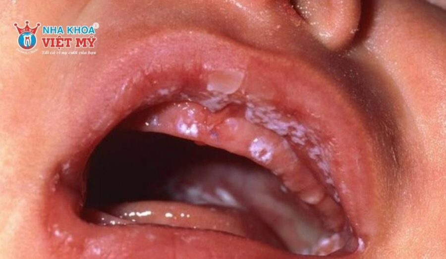 Nấm miệng và tưa lưỡi gây đau đớn và khó chịu cho trẻ