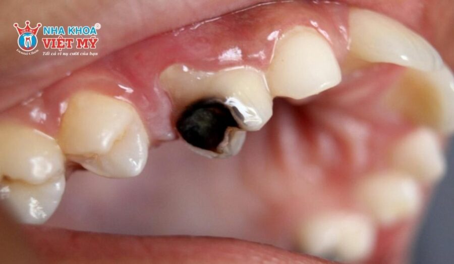 Các bệnh răng miệng gây nhiều phiền toái cho trẻ
