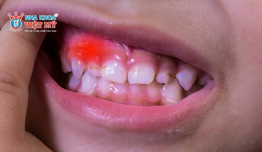 Sự tổn thương trong khoang miệng là nguyên nhân gây bệnh răng miệng