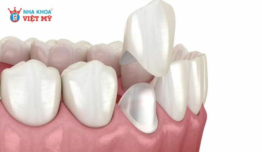 7 trường hợp nên chọn răng sứ Vita