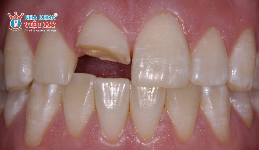 Cần tìm hiểu rõ nguyên nhân trước khi xử lý khi răng bị vỡ