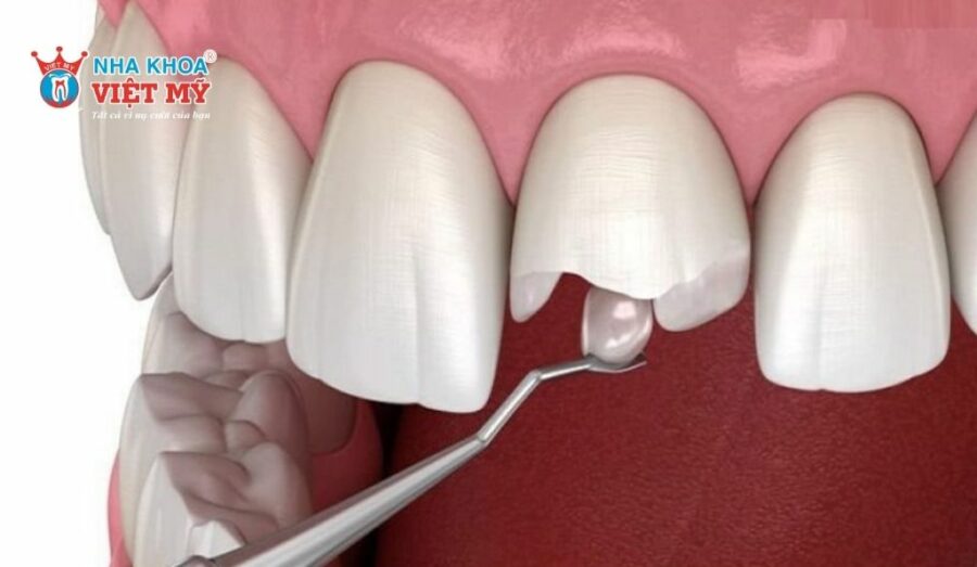 Răng bị vỡ dễ dàng quan sát thấy bằng mắt thường