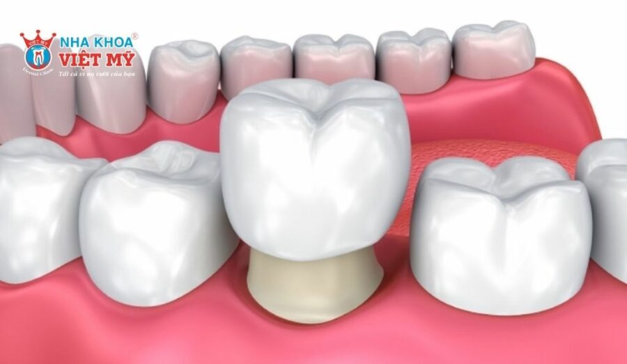 Xử lý khi răng bị vỡ bằng bọc răng sứ