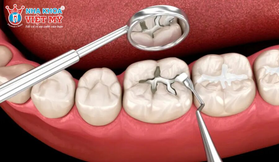 Nếu tình trạng sâu chưa quá nặng có thể áp dụng phương pháp trám răng để trị nhức răng có lỗ