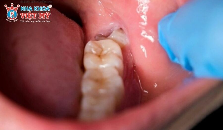 Chi phí nhổ răng khôn có bảo hiểm y tế là bao nhiêu?