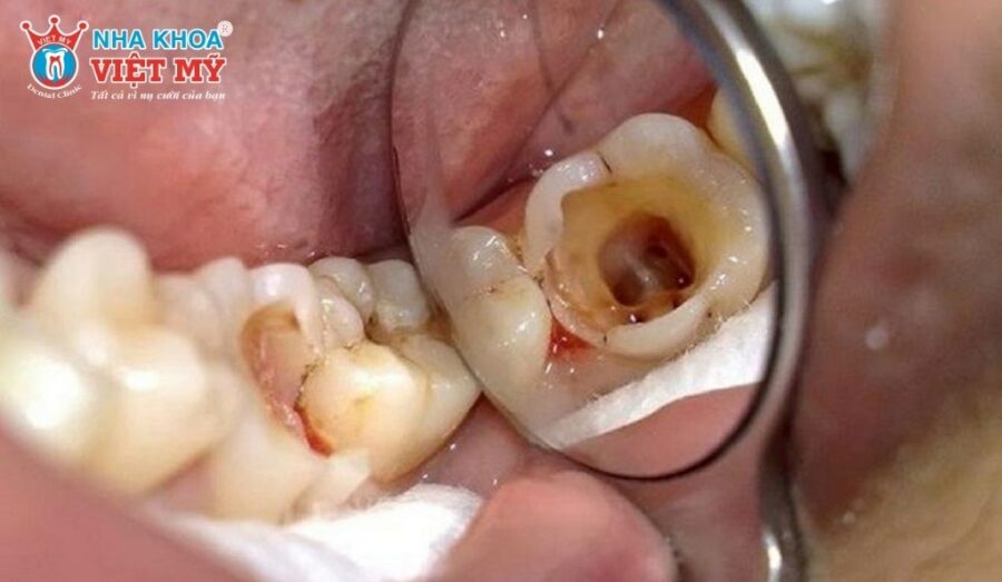 Nguyên nhân dẫn đến tình trạng đau nhức khi răng bị sâu