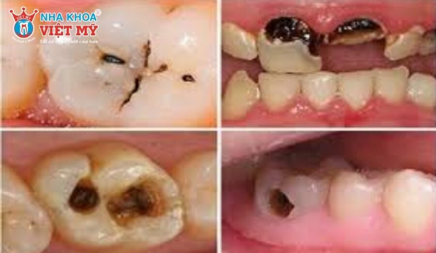 Mẹo chữa đau răng sâu giúp xoa dịu cơn đau tức thời