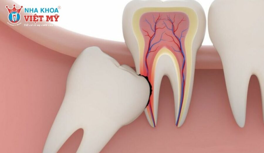 Răng khôn hàm dưới thường mọc khi ở độ tuổi trưởng thành