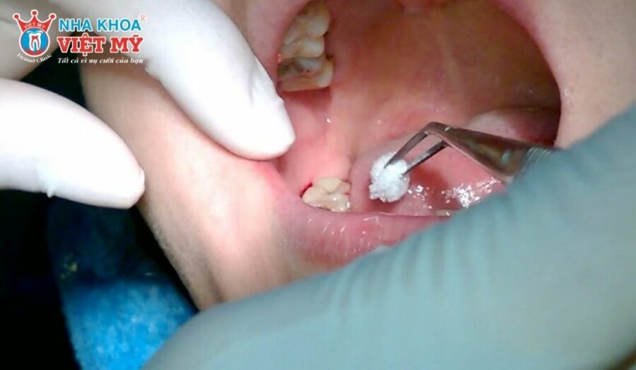 Những dấu hiệu nhận biết khi răng khôn hàm dưới bắt đầu mọc