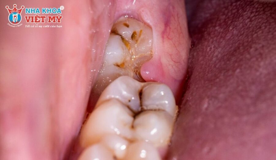 Răng khôn hàm dưới mọc lệch lâu ngày có thể dẫn đến tình trạng sâu răng nặng