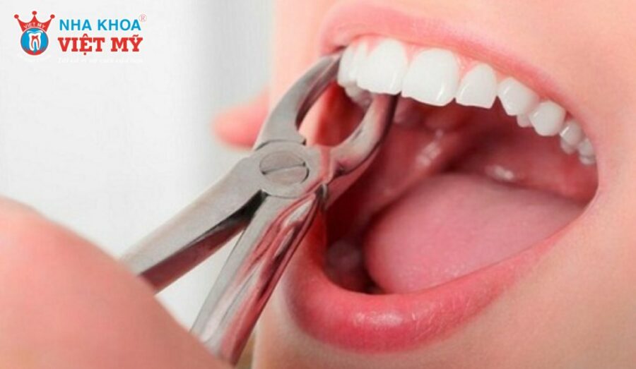 Nhổ răng là giải pháp cuối cùng nếu răng bị hư hỏng quá nặng