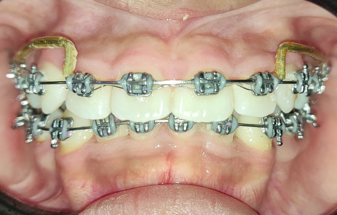 Khánh Linh sau khi niềng răng tại Nha Khoa Việt Mỹ