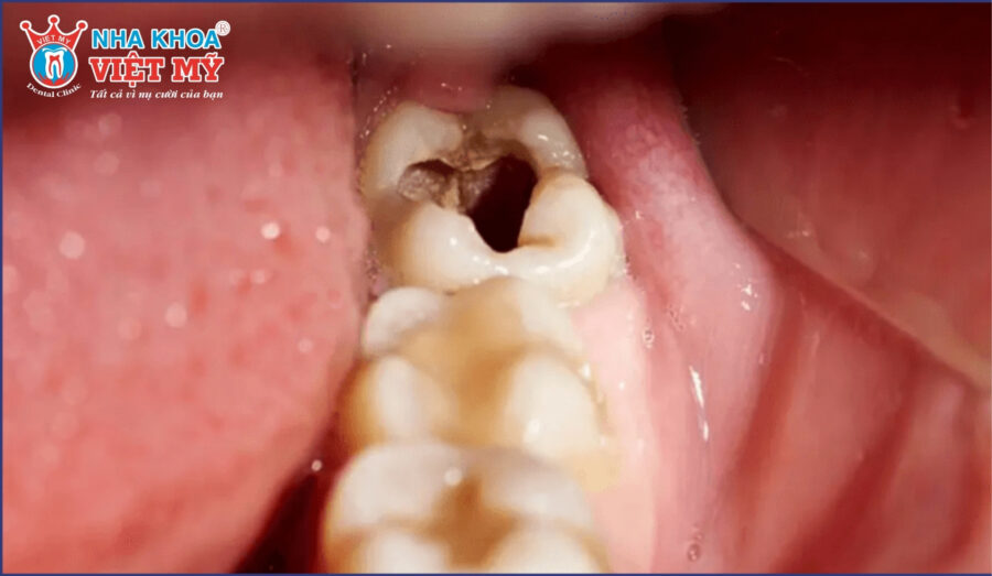 Nhức răng có lỗ xảy ra như thế nào