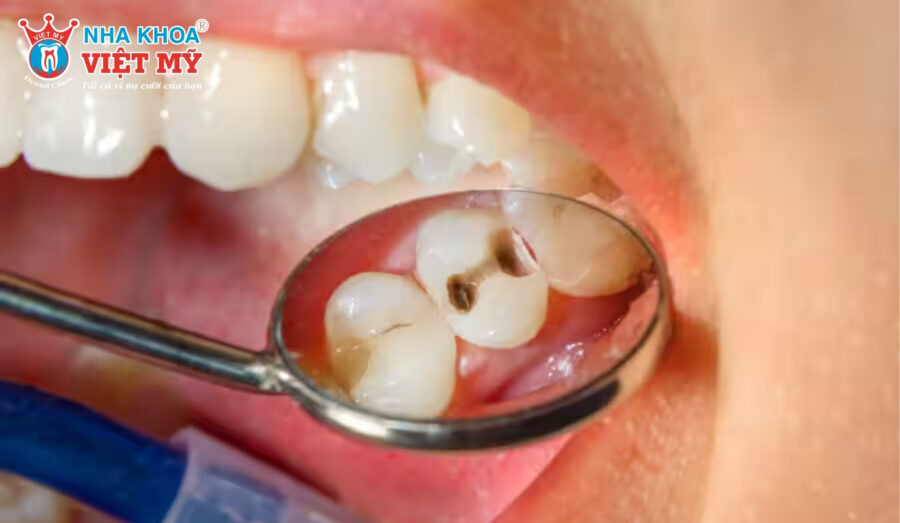 Răng xuất hiện những đốm màu bất thường, gây nhạy cảm và ê buốt