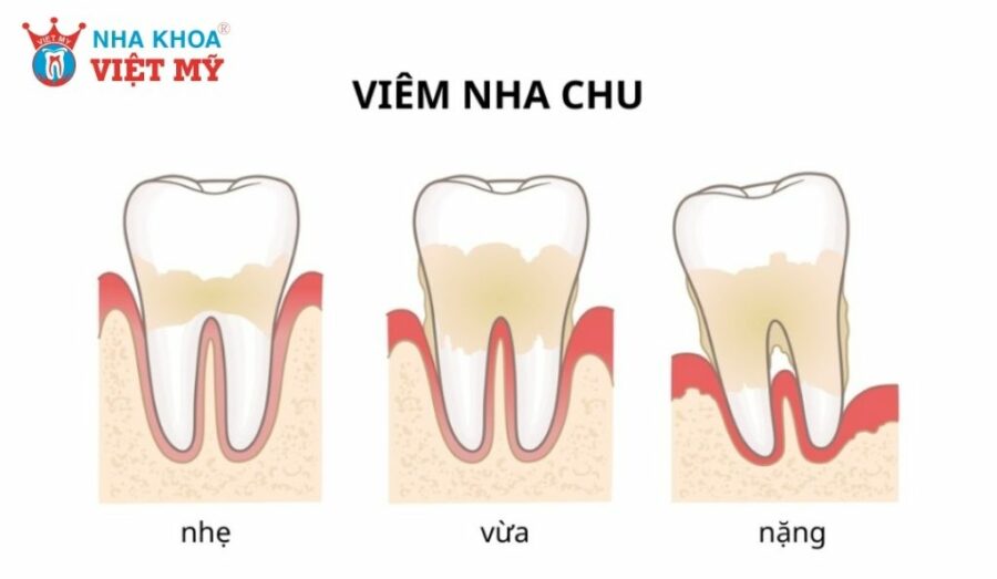 Viêm nha chu là nguyên nhân hàng đầu dẫn đến răng lung lay ở người trưởng thành