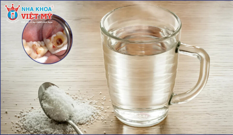 Súc miệng bằng nước muối kháng khuẩn, giảm đau viêm