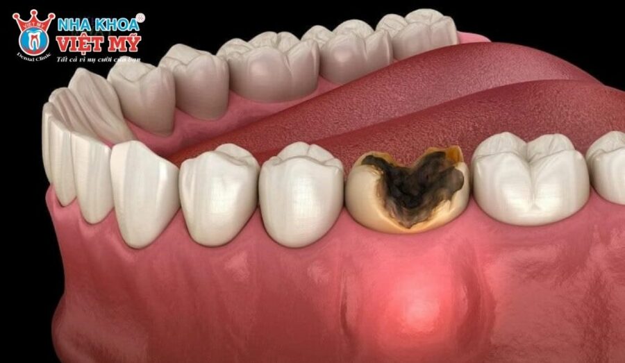 Sâu nặng nếu không được điều trị kịp thời sẽ dẫn đến tình trạng viêm mủ chân răng