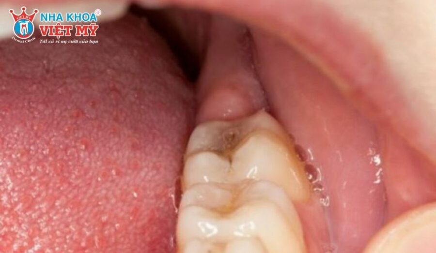 Nên đi thăm khám bác sĩ sớm khi có dấu hiệu mọc răng không hàm dưới