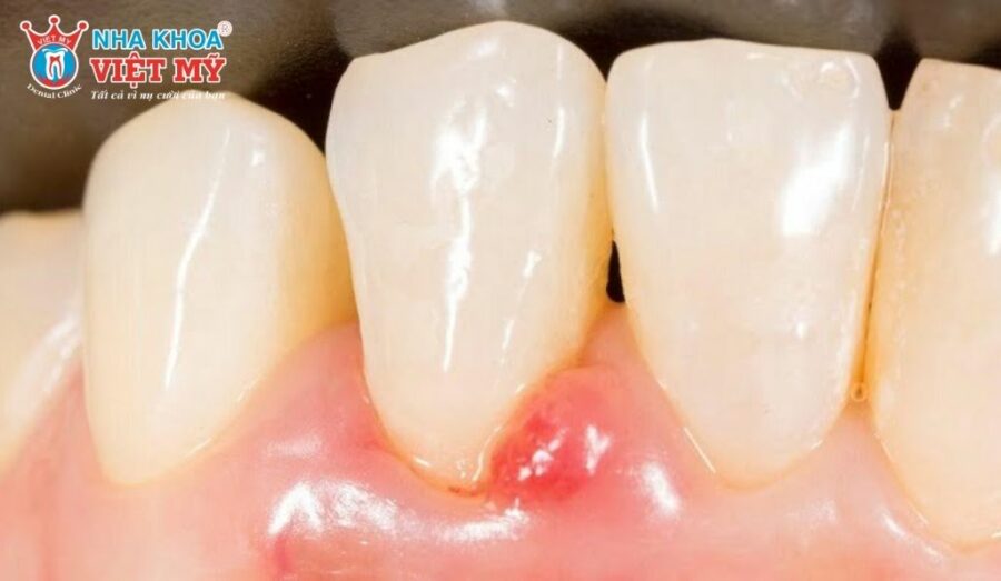 Bác sĩ sẽ tiến hành loại bỏ, nạo sạch ổ viêm để trị dứt điểm mủ chân răng