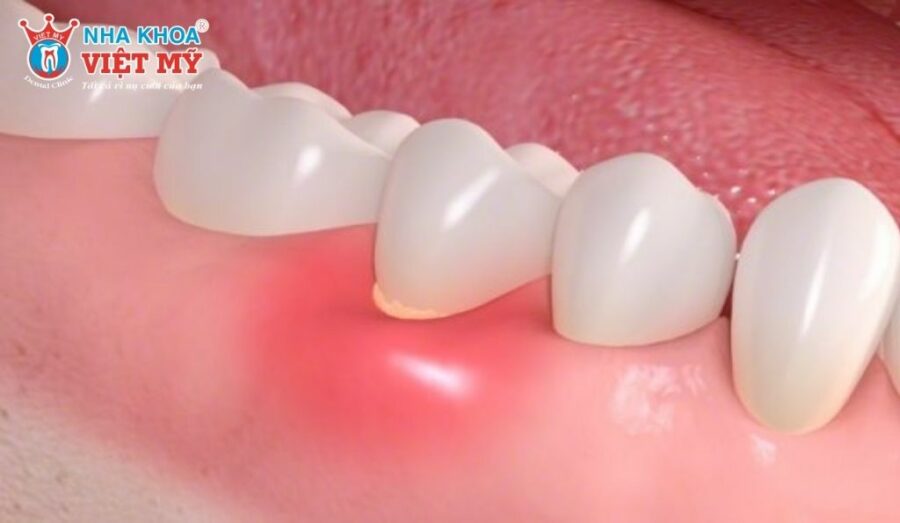 Mủ chân răng làm phần lợi xung quanh sưng tấy