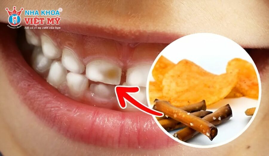 Thực phẩm cần tránh để bảo vệ răng