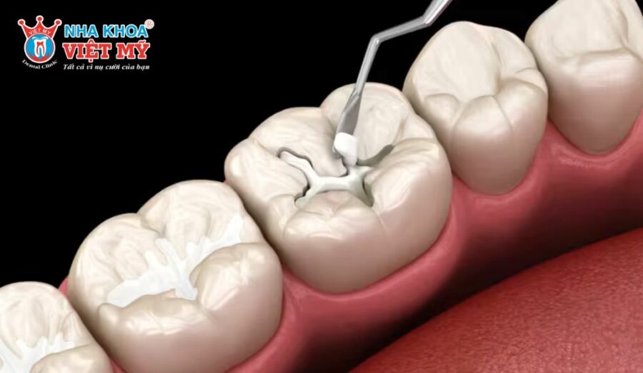 Chỉ nên trám răng khi răng gặp vấn đề ở mức độ nhẹ