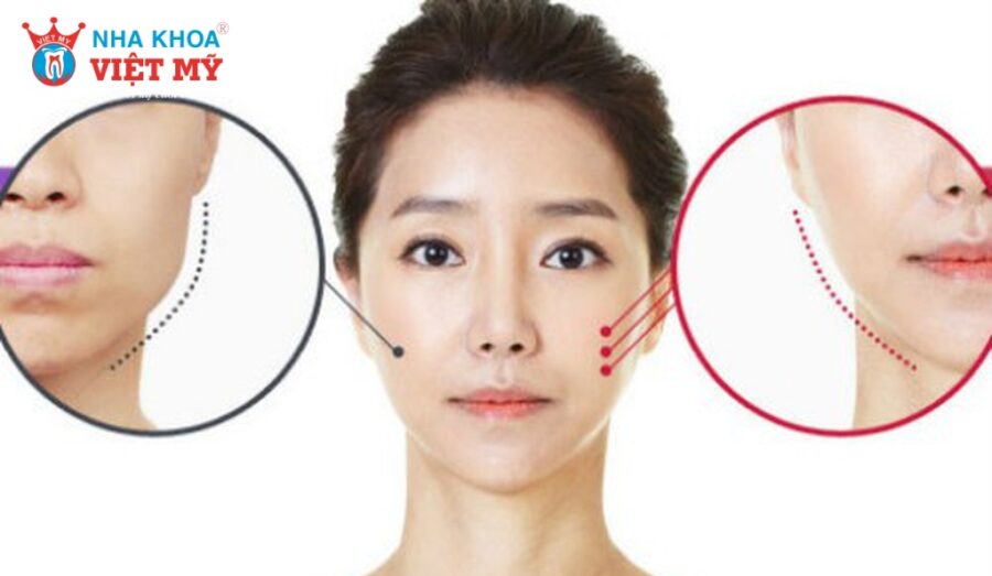 Nhai nhiều 1 bên khiến gương mặt mất cân đối