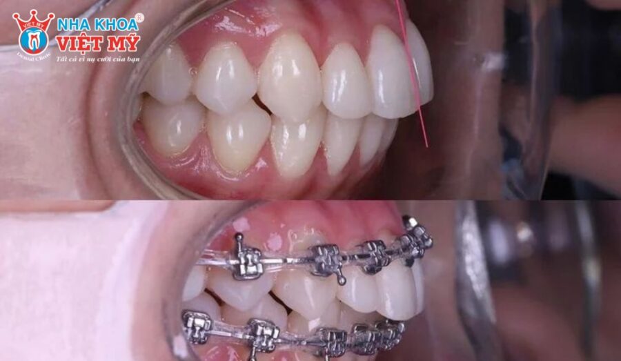 Nếu hô chủ yếu do răng có thể niềng để cải thiện