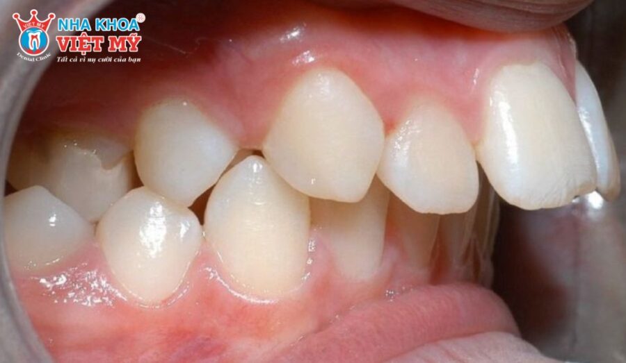 Có nhiều nguyên nhân gây ra tình trạng răng hô nặng