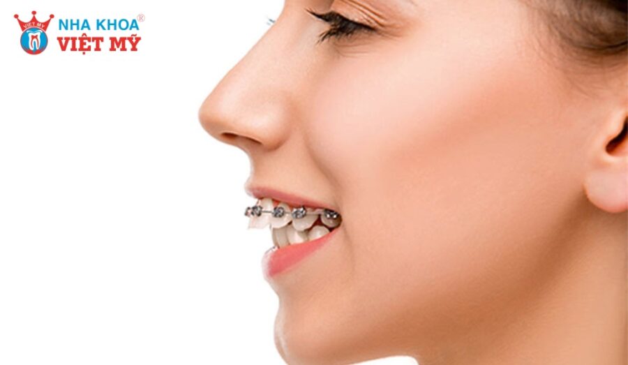 Răng hô nặng có niềng được không tuỳ vào từng trường hợp