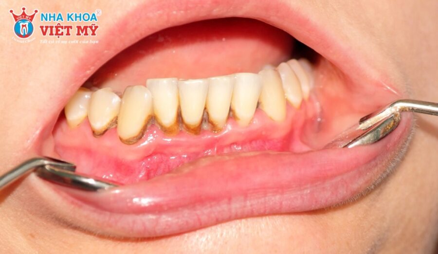 Tác hại của tẩy trắng răng không đúng cách