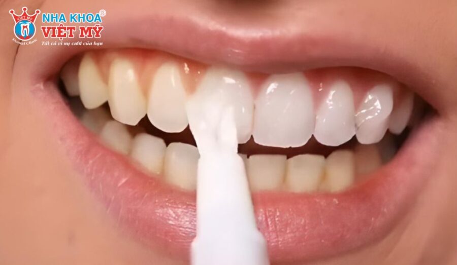 Tự ý tẩy trắng răng tại nhà gây ra nhiều tác hại