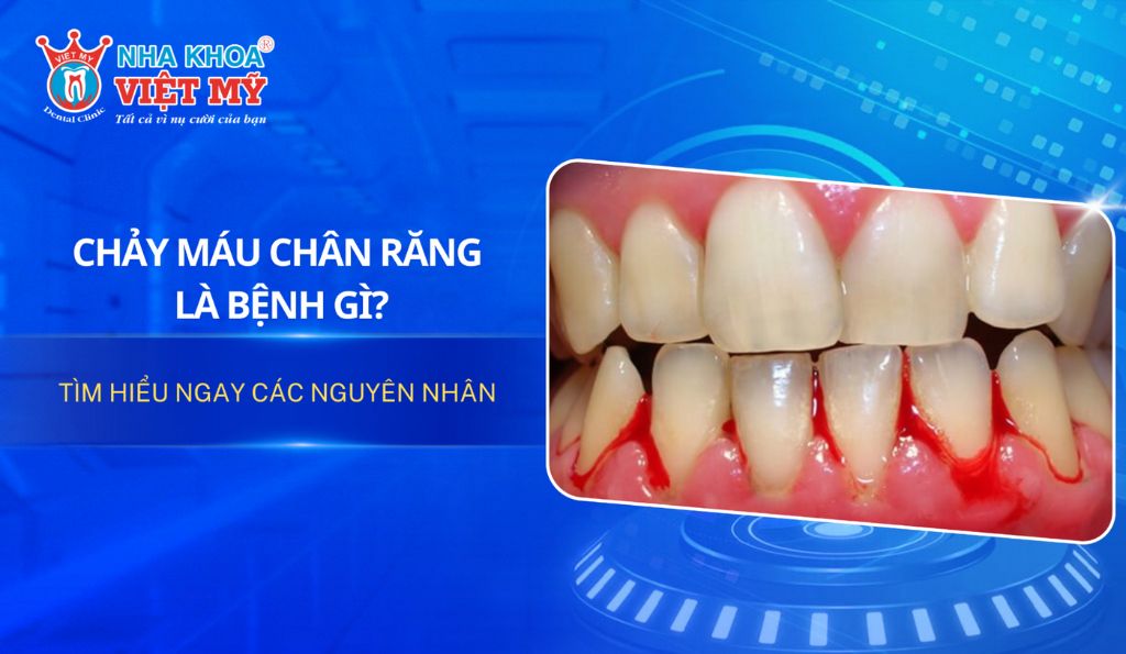Chảy máu chân răng là bệnh gì? Nguyên nhân gây chảy máu chân răng?
